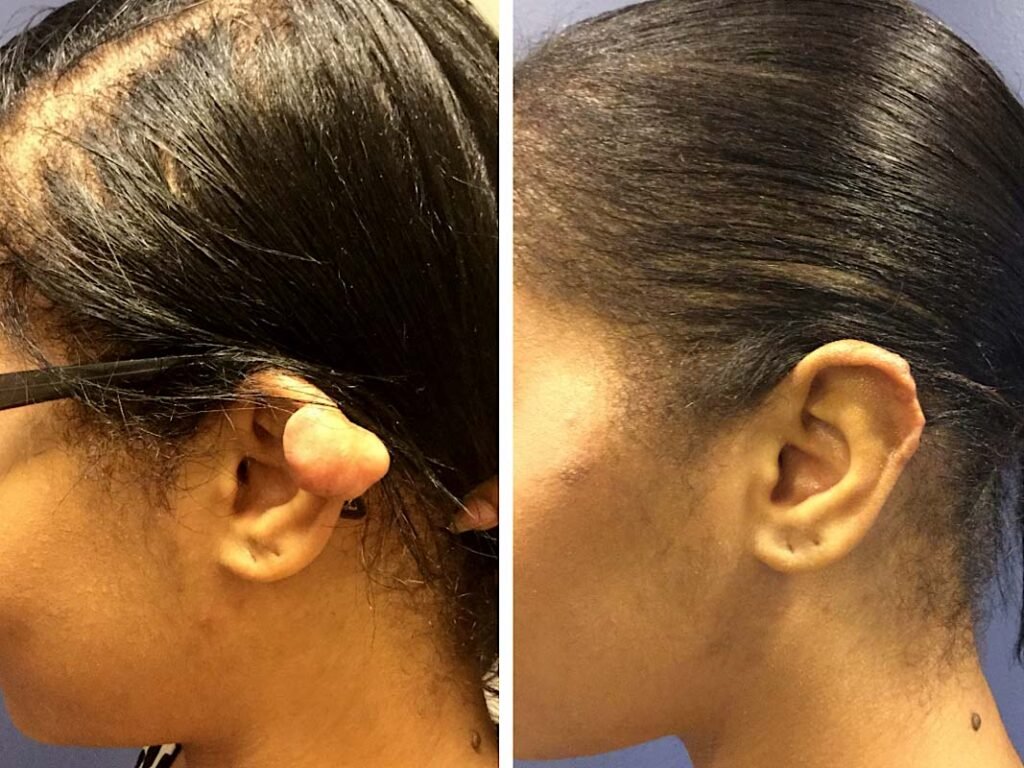 recurrent keloid scar before and after specialist treatment