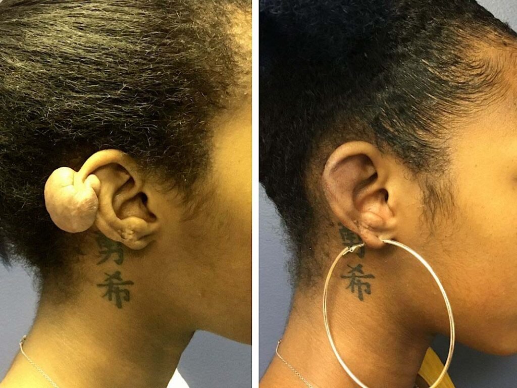 ear keloid removal