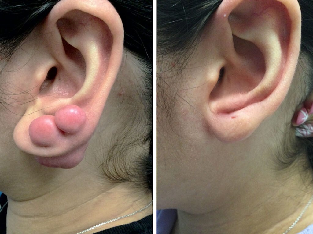 remove keloid