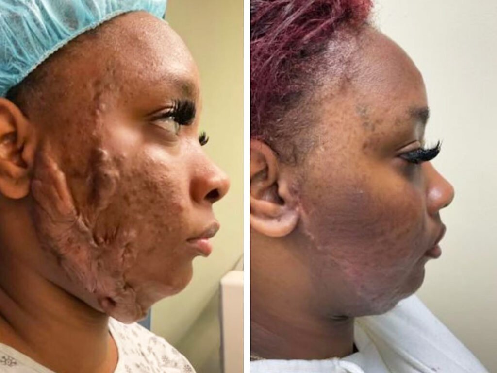 facial-keloid-removal-before-after-01.jpg