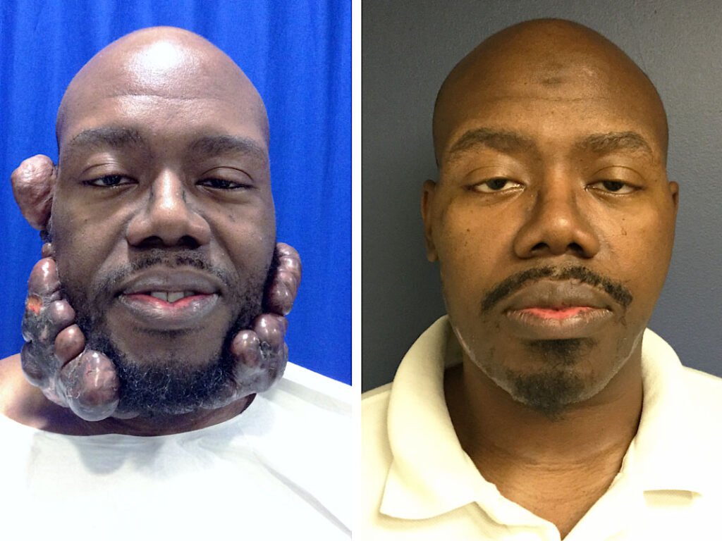 facial-keloid-removal-before-after-03.jpg