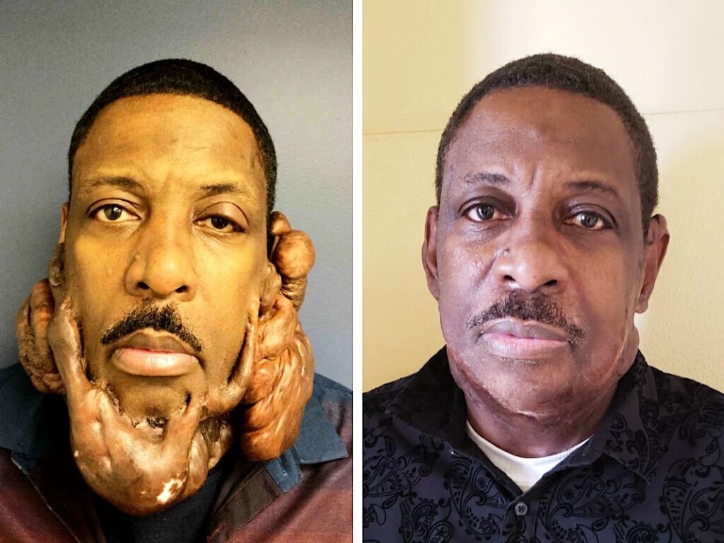 facial-keloid-removal-before-after-02.jpg