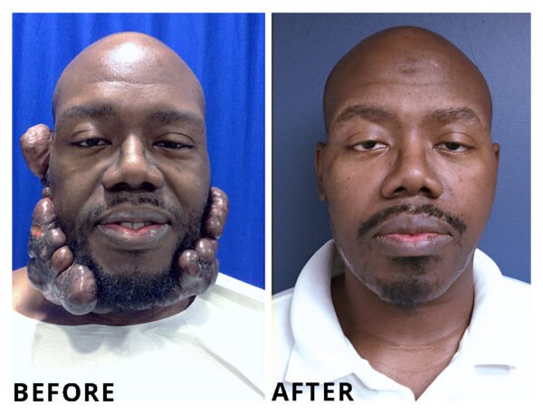 Keloid-removal-Keenan